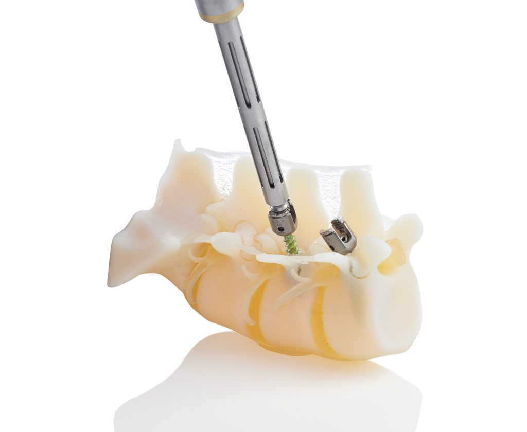 Stratasys BioMimics 3D-printed model of a spine section, made from multiple appropriate materials on a J750 AM system. The model's material properties allow it to be used for training surgeons; here, a pedicle screw is being inserted. (Image courtesy Stratasys)